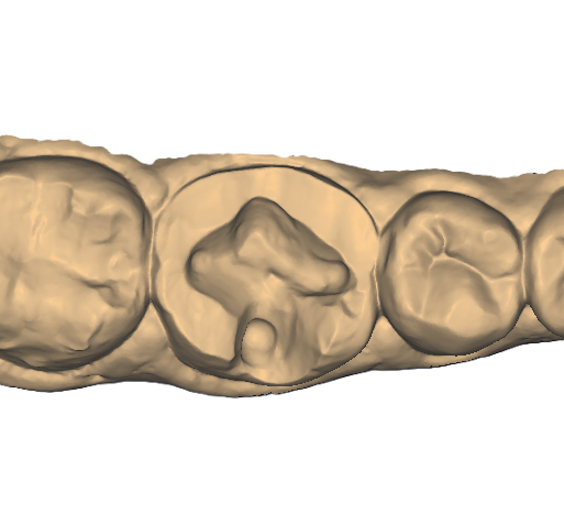 Partial Onlay Model 1